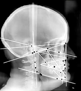 analyse céphalométrique, bonne posture